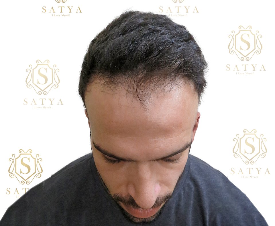 before-hair-transplant