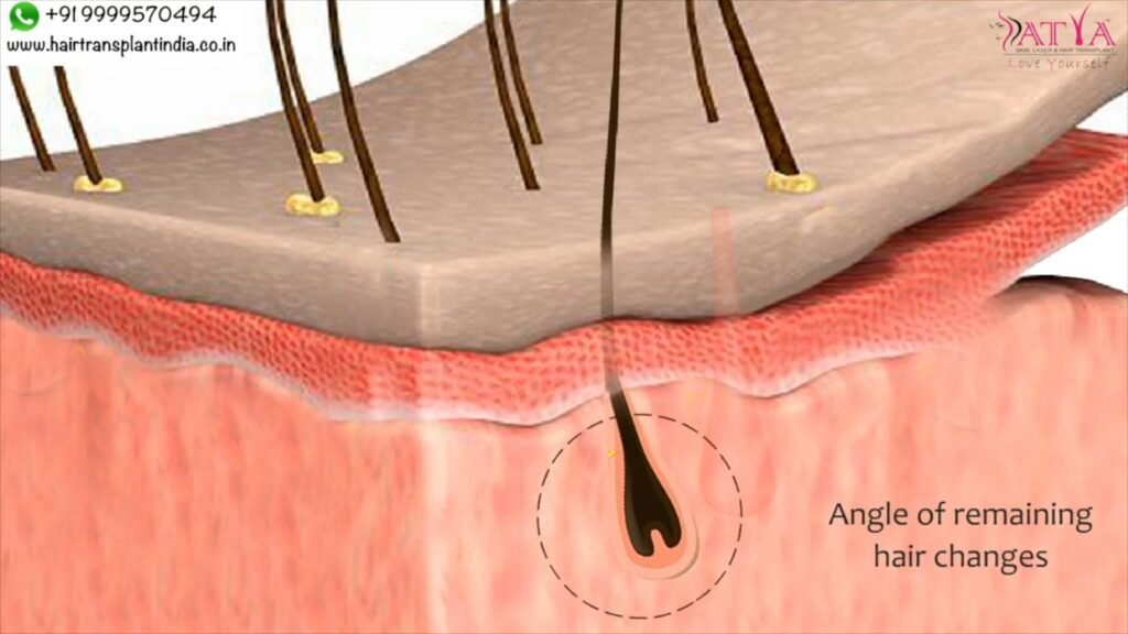 Importance of Donor Area in Hair Transplantation
